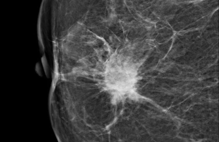 Симптом лучистой тени на маммограмме